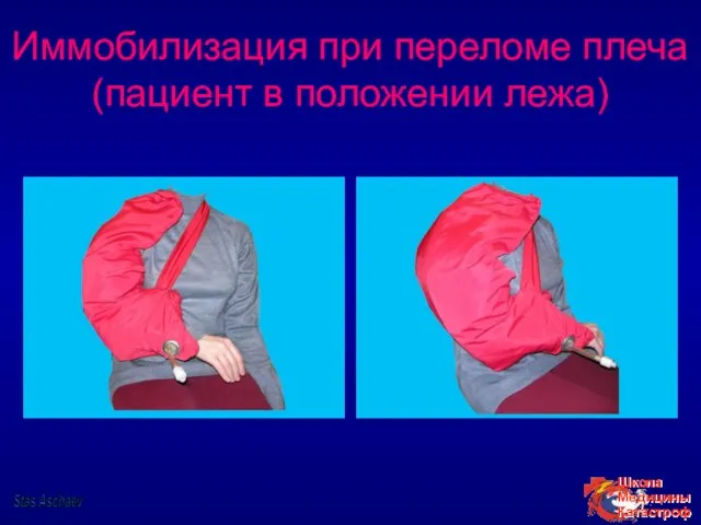 Иммобилизация при переломе плеча (пациент в положении лежа) Stas Aschaev