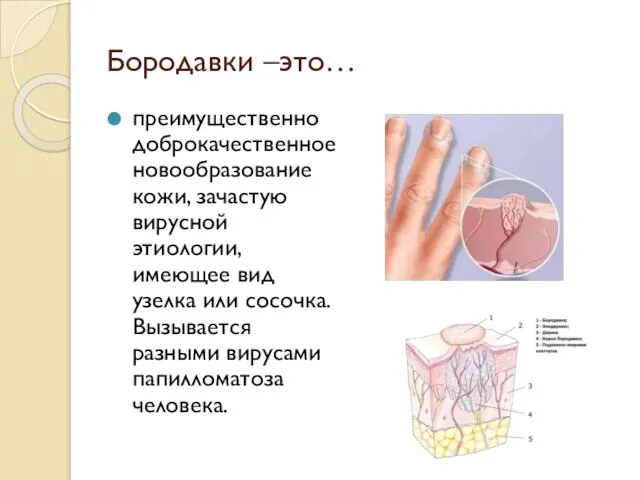 Бородавки –это… преимущественно доброкачественное новообразование кожи, зачастую вирусной этиологии, имеющее вид узелка