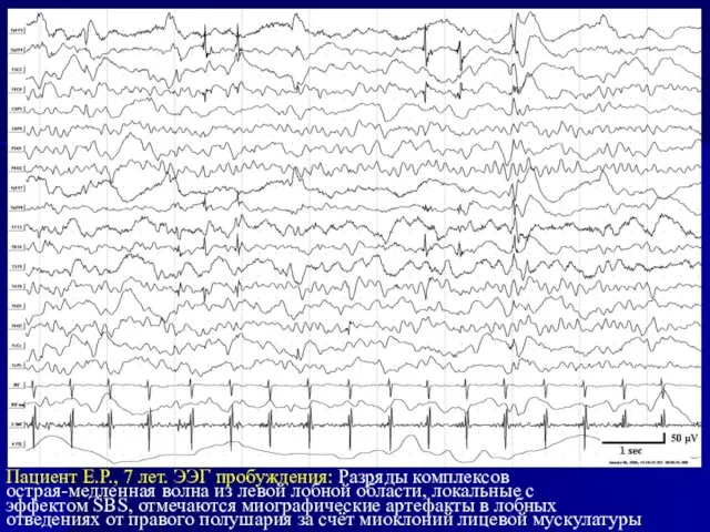 Пациент Е.Р., 7 лет. ЭЭГ пробуждения: Разряды комплексов острая-медленная волна из левой