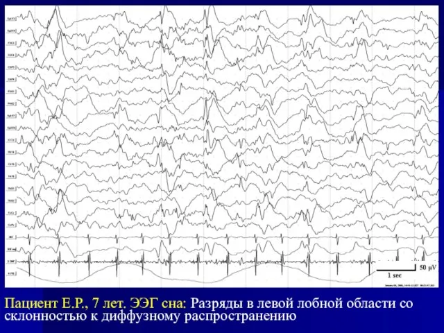 Пациент Е.Р., 7 лет. ЭЭГ сна: Разряды в левой лобной области со склонностью к диффузному распространению