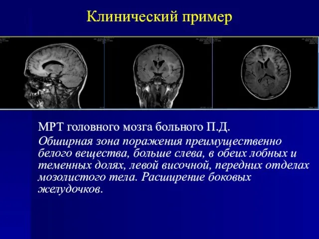 Клинический пример МРТ головного мозга больного П.Д. Обширная зона поражения преимущественно белого