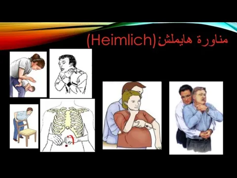 :(Heimlich) مناورة هايملش