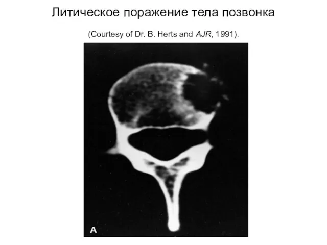 Литическое поражение тела позвонка (Courtesy of Dr. B. Herts and AJR, 1991).