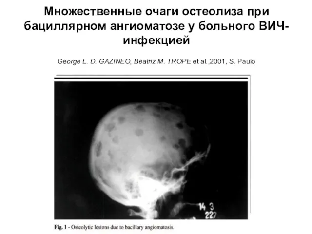 Множественные очаги остеолиза при бациллярном ангиоматозе у больного ВИЧ-инфекцией George L. D.