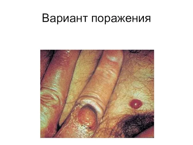 Вариант поражения