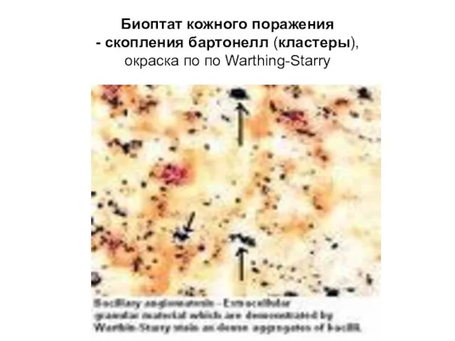 Биоптат кожного поражения - скопления бартонелл (кластеры), окраска по по Warthing-Starry