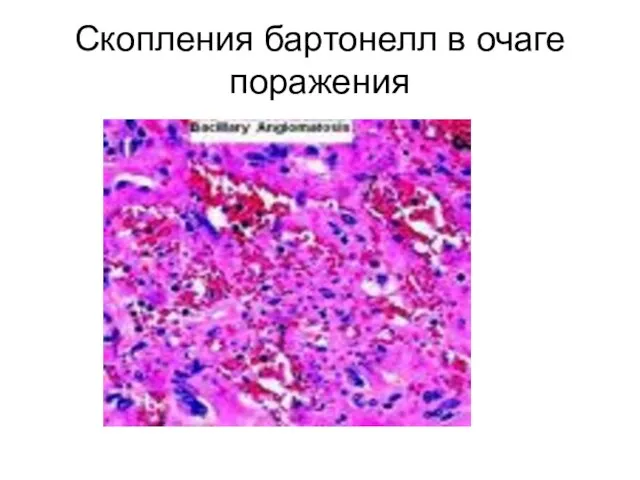 Скопления бартонелл в очаге поражения