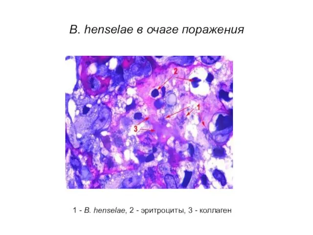 B. henselae в очаге поражения 1 - B. henselae, 2 - эритроциты, 3 - коллаген
