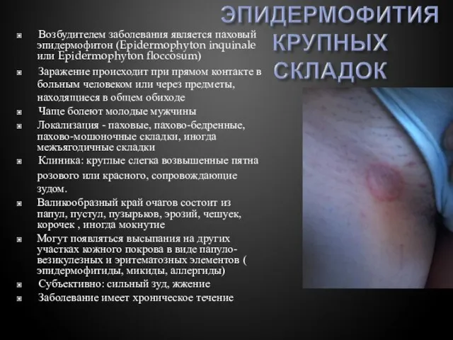 ▣ Возбудителем заболевания является паховый эпидермофитон (Epidermophyton inquinale или Epidermophyton floccosum) ▣