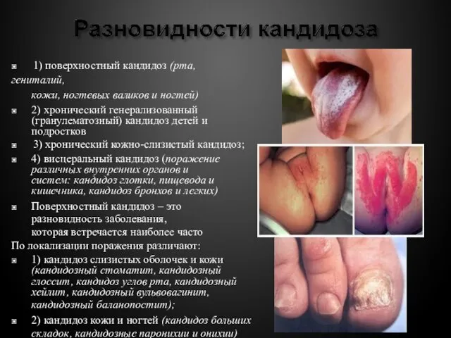 ▣ 1) поверхностный кандидоз (рта, гениталий, кожи, ногтевых валиков и ногтей) ▣