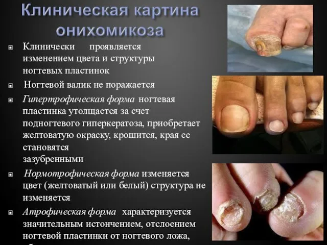 ▣ Клинически проявляется изменением цвета и структуры ногтевых пластинок ▣ Ногтевой валик
