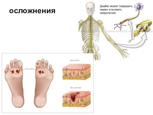 осложнения