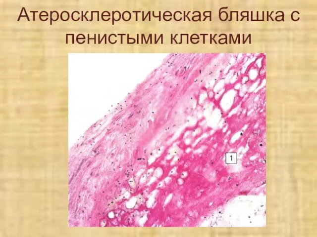 Атеросклеротическая бляшка с пенистыми клетками