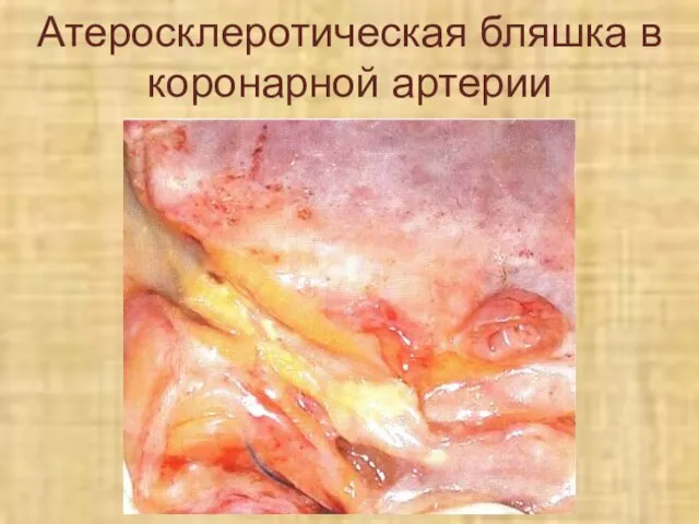 Атеросклеротическая бляшка в коронарной артерии