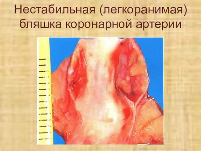 Нестабильная (легкоранимая) бляшка коронарной артерии