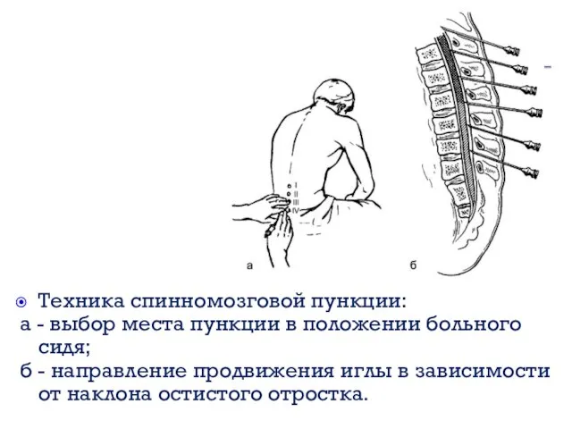 Техника спинномозговой пункции: а - выбор места пункции в положении больного сидя;