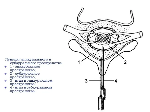 Пункция эпидурального и субдурального пространства: 1 - эпидуральное пространство; 2 - субдуральное