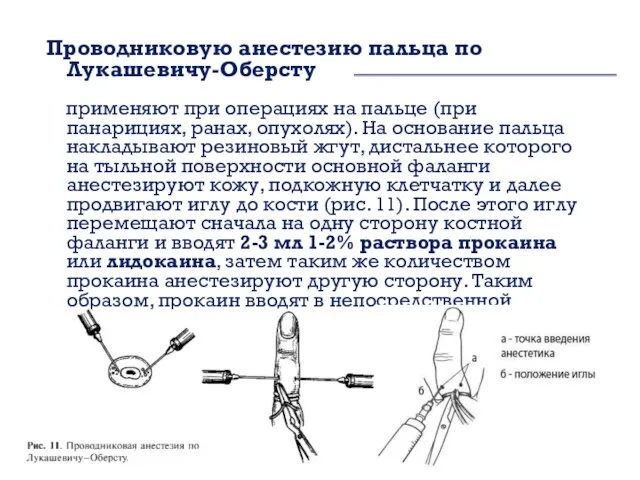 Проводниковую анестезию пальца по Лукашевичу-Оберсту применяют при операциях на пальце (при панарициях,