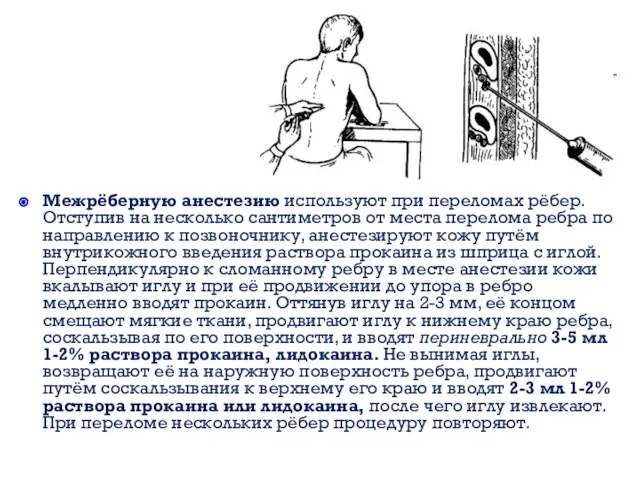 Межрёберную анестезию используют при переломах рёбер. Отступив на несколько сантиметров от места