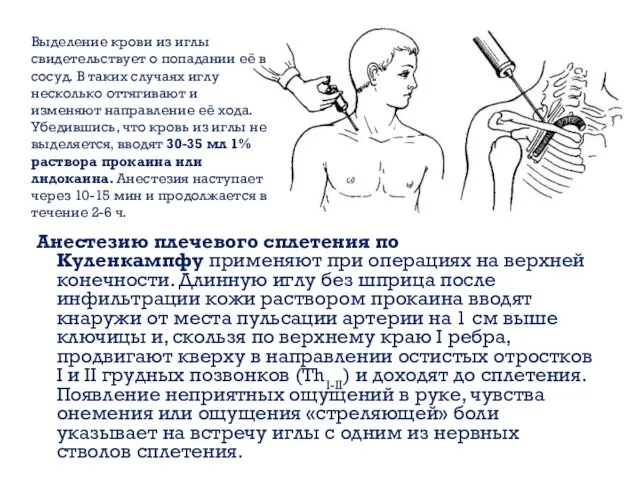 Анестезию плечевого сплетения по Куленкампфу применяют при операциях на верхней конечности. Длинную