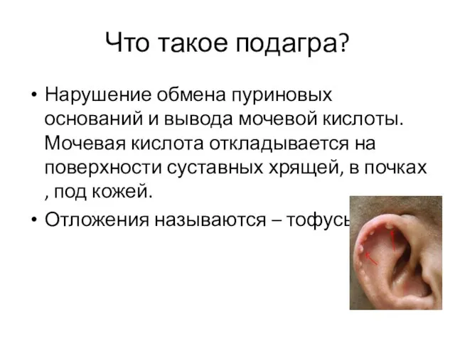 Что такое подагра? Нарушение обмена пуриновых оснований и вывода мочевой кислоты. Мочевая