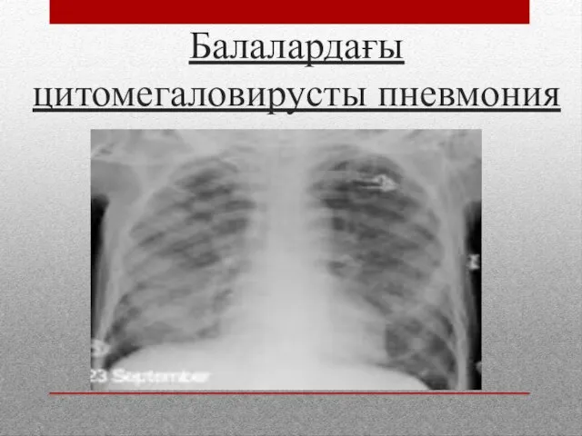 Балалардағы цитомегаловирусты пневмония