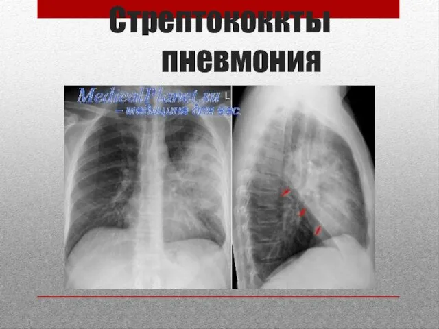 Стрептококкты пневмония