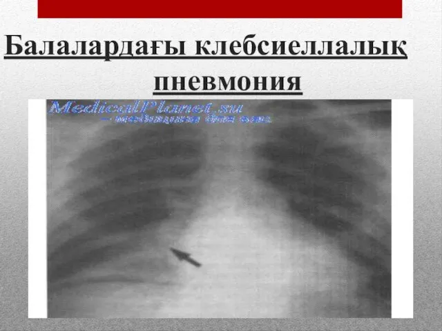 Балалардағы клебсиеллалық пневмония