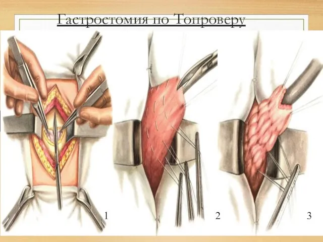 Гастростомия по Топроверу 1 2 3