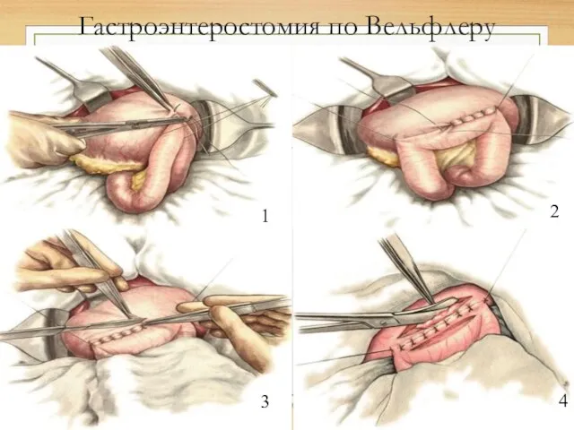 Гастроэнтеростомия по Вельфлеру 1 2 3 4