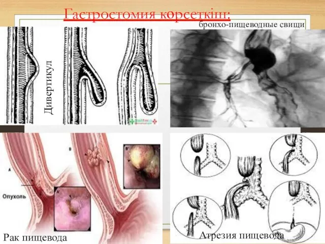 Гастростомия көрсеткіш: бронхо-пищеводные свищи Атрезия пищевода Дивертикул Рак пищевода
