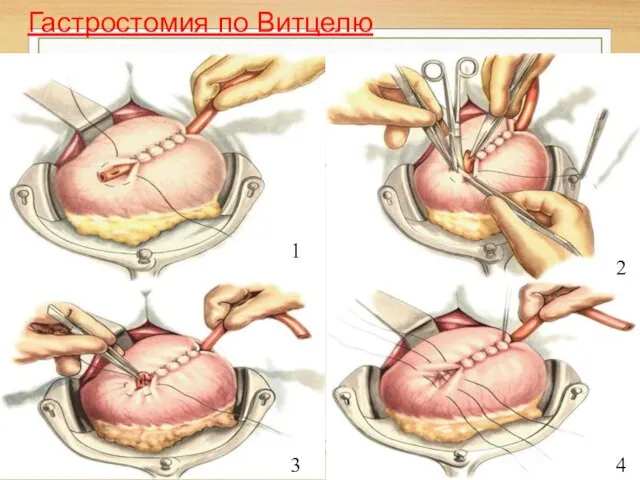 Гастростомия по Витцелю 1 2 3 4