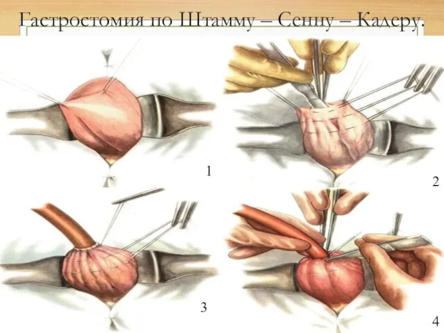 Гастростомия по Штамму – Сенну – Кадеру. 1 2 3 4