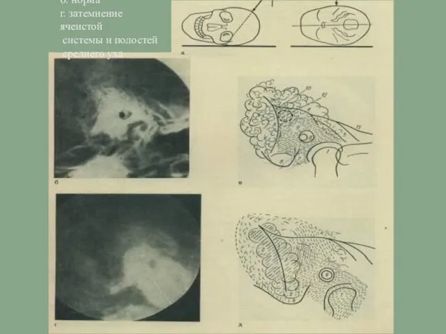 б. норма г. затемнение ячеистой системы и полостей среднего уха