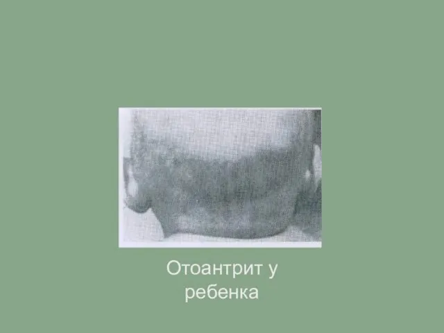 Отоантрит у ребенка