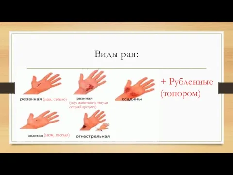 Виды ран: + Рубленные (топором) (нож, стекло) (нож, гвозди) (укус животного, тянули острый предмет)