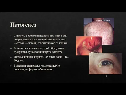 Патогенез 12 Слизистые оболочки полости рта, глаз, носа, поврежденная кожа → лимфатические