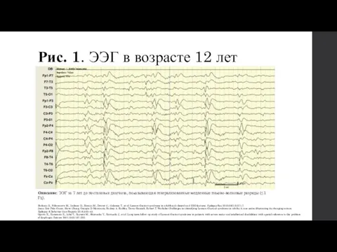 Рис. 1. ЭЭГ в возрасте 12 лет Описание: ЭЭГ за 7 лет