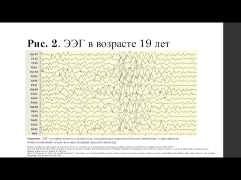 Рис. 2. ЭЭГ в возрасте 19 лет Описание: ЭЭГ при представлении и