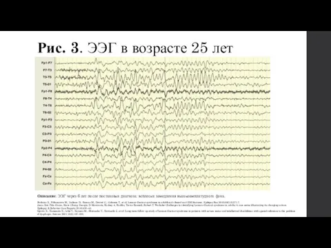 Рис. 3. ЭЭГ в возрасте 25 лет Описание: ЭЭГ через 6 лет