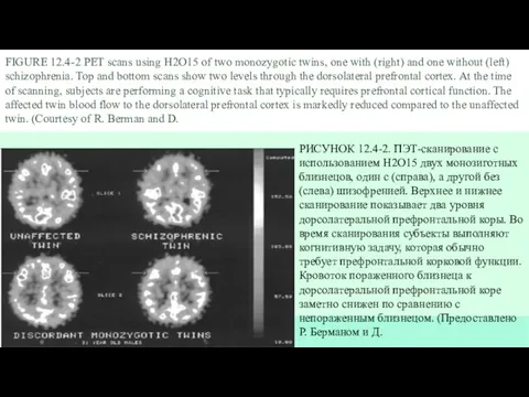 FIGURE 12.4-2 PET scans using H2O15 of two monozygotic twins, one with