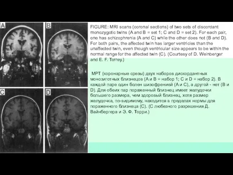 FIGURE: MRI scans (coronal sections) of two sets of discordant monozygotic twins