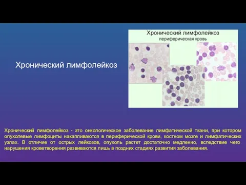 Хронический лимфолейкоз Хронический лимфолейкоз - это онкологическое заболевание лимфатической ткани, при котором