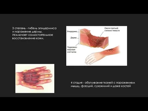 3 степень - гибель эпидермиса и поражение дермы. Исключает самостоятельное восстановление кожи.