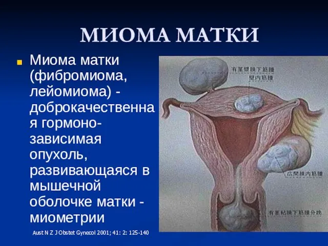 МИОМА МАТКИ Миома матки (фибромиома, лейомиома) - доброкачественная гормоно-зависимая опухоль, развивающаяся в
