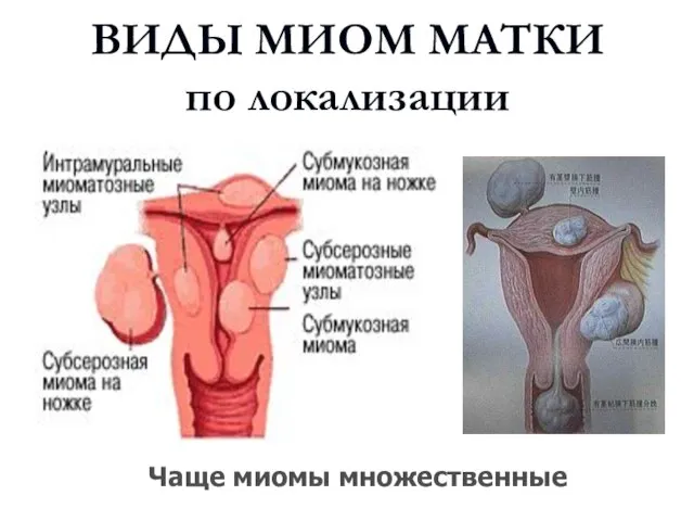 ВИДЫ МИОМ МАТКИ по локализации Comprehensive Gynecology, 4th ed., Copyright C 2001