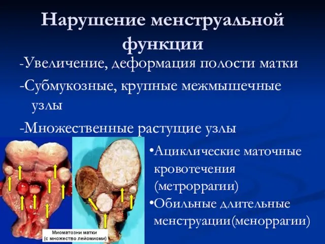 Нарушение менструальной функции -Увеличение, деформация полости матки -Субмукозные, крупные межмышечные узлы -Множественные