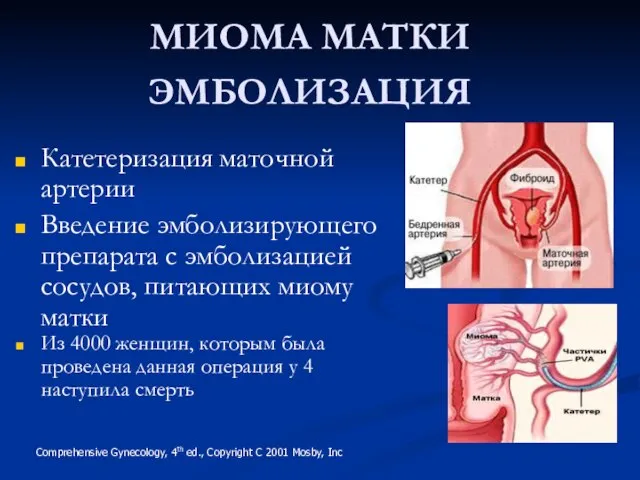 МИОМА МАТКИ ЭМБОЛИЗАЦИЯ Катетеризация маточной артерии Введение эмболизирующего препарата с эмболизацией сосудов,