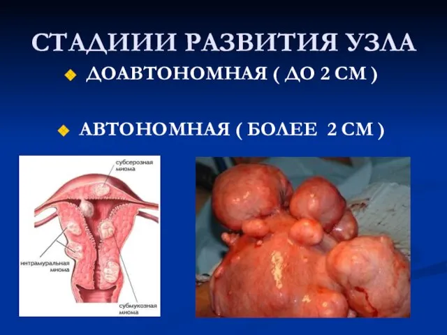 СТАДИИИ РАЗВИТИЯ УЗЛА ДОАВТОНОМНАЯ ( ДО 2 СМ ) АВТОНОМНАЯ ( БОЛЕЕ 2 СМ )