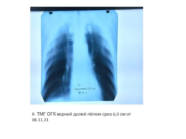 R ТМГ ОГК верней долей лёгких срез 6,0 см от 08.11.21
